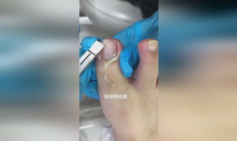 甲沟炎修脚视频,专业指导，轻松告别脚部困扰